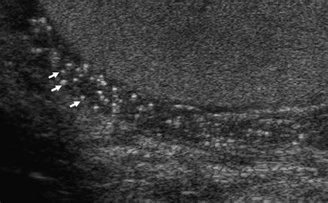 dancing sperm|Dancing Sperm on Scrotal Ultrasound: Is It Associated .